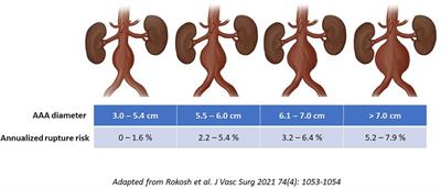 Modern management of ruptured abdominal aortic aneurysm